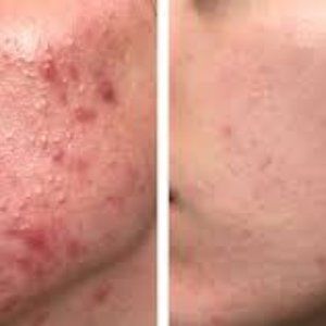 Anti acne serum